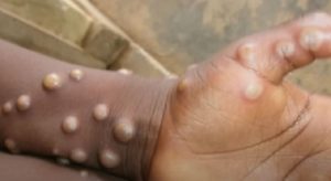 220519162059 monkeypox